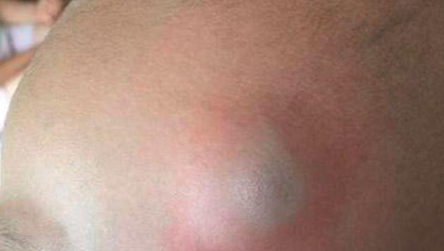 婴儿头被摔了怎么办_婴儿头被摔了的危害