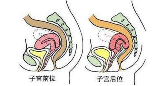 子宫移位是怎么回事  第1张