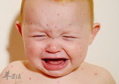 春季幼儿易有湿疹 教你方法缓解