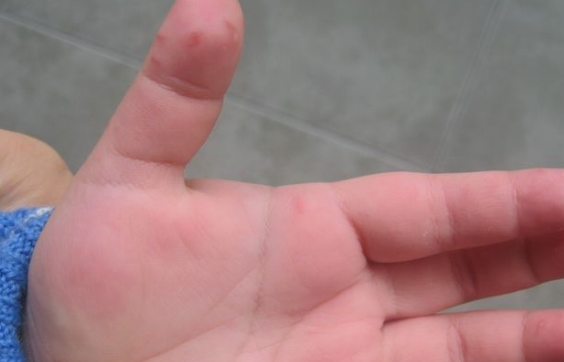 儿童患手足口病的原因有哪些  第1张