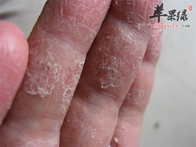 小暑节气的防病保健