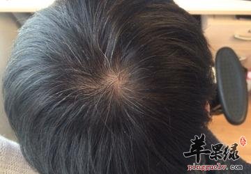 分情况帮助青少年治疗少白头