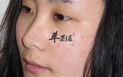 日常生活中怎样去掉脸上的色斑  第3张