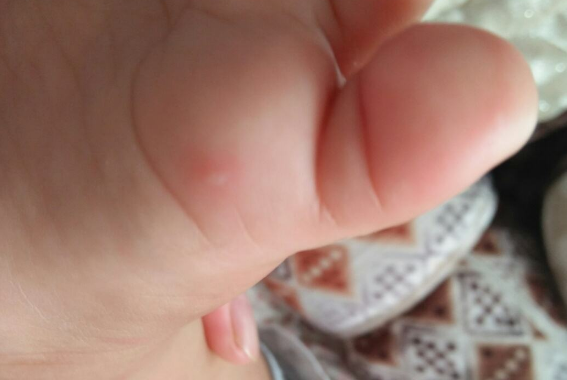 儿童患手足口病会出现哪些症状  第2张