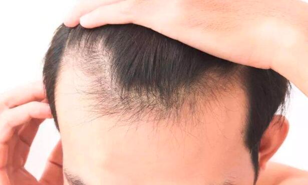 男人吃什么可以防止掉头发  第1张